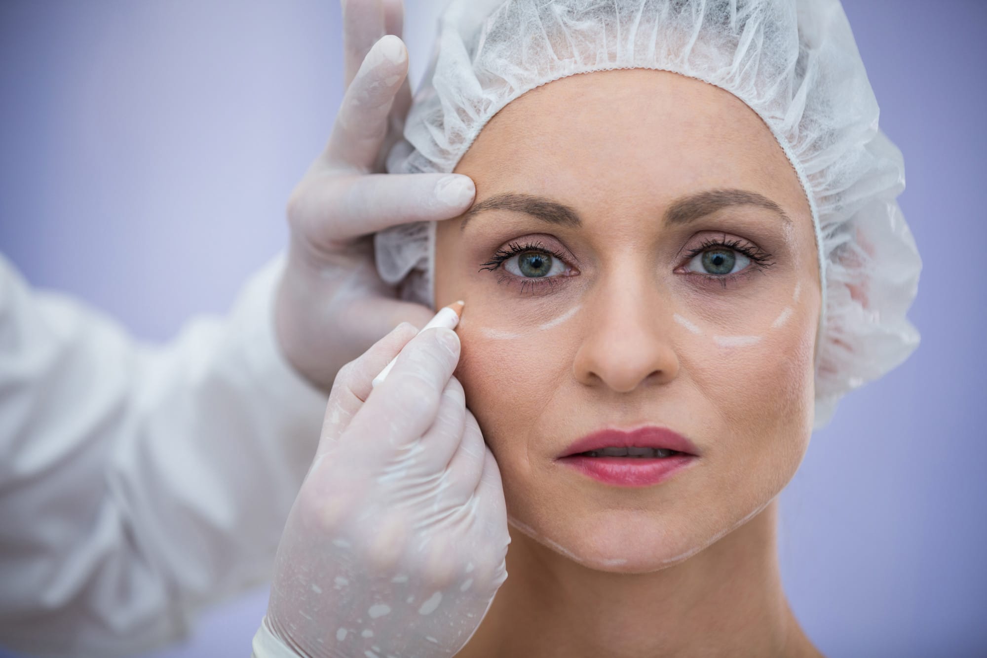 Non-Surgical Blepharoplasty Protocol in Miami, FL