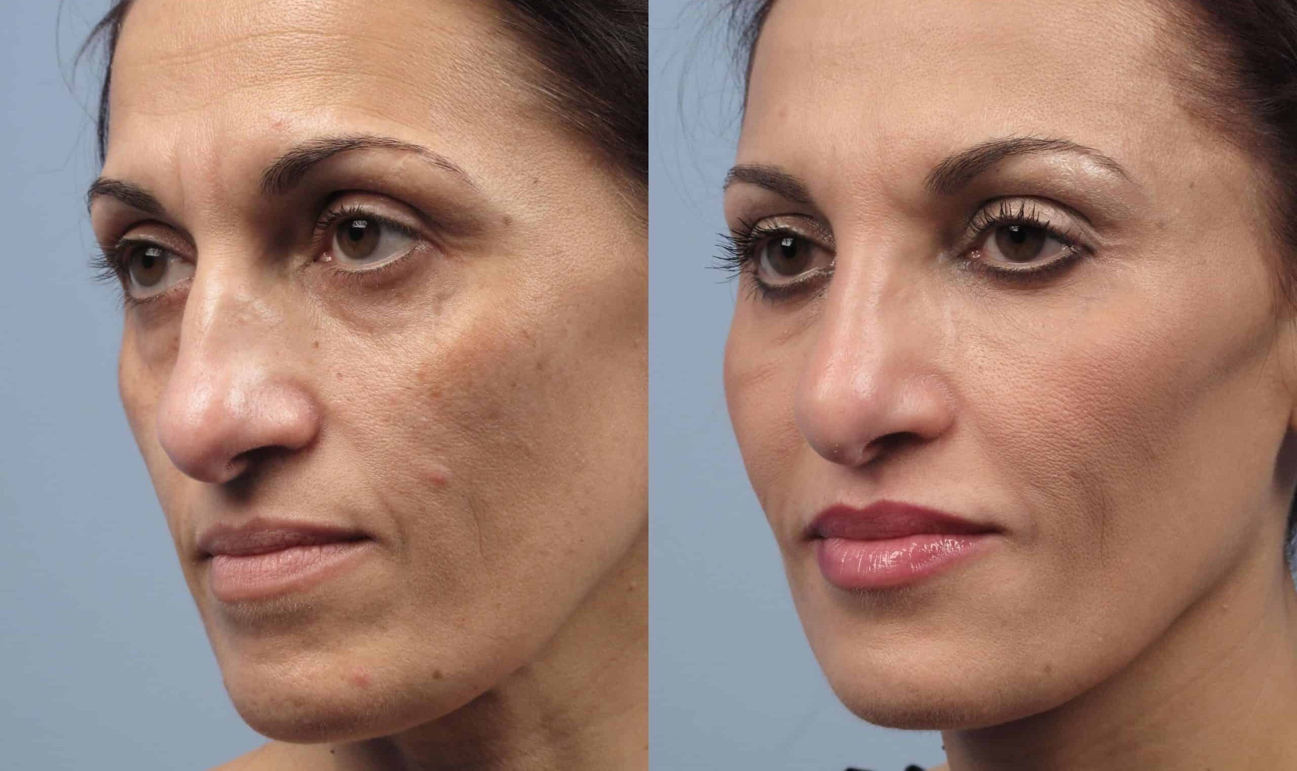 Non-Surgical Blepharoplasty Protocol in Miami, FL