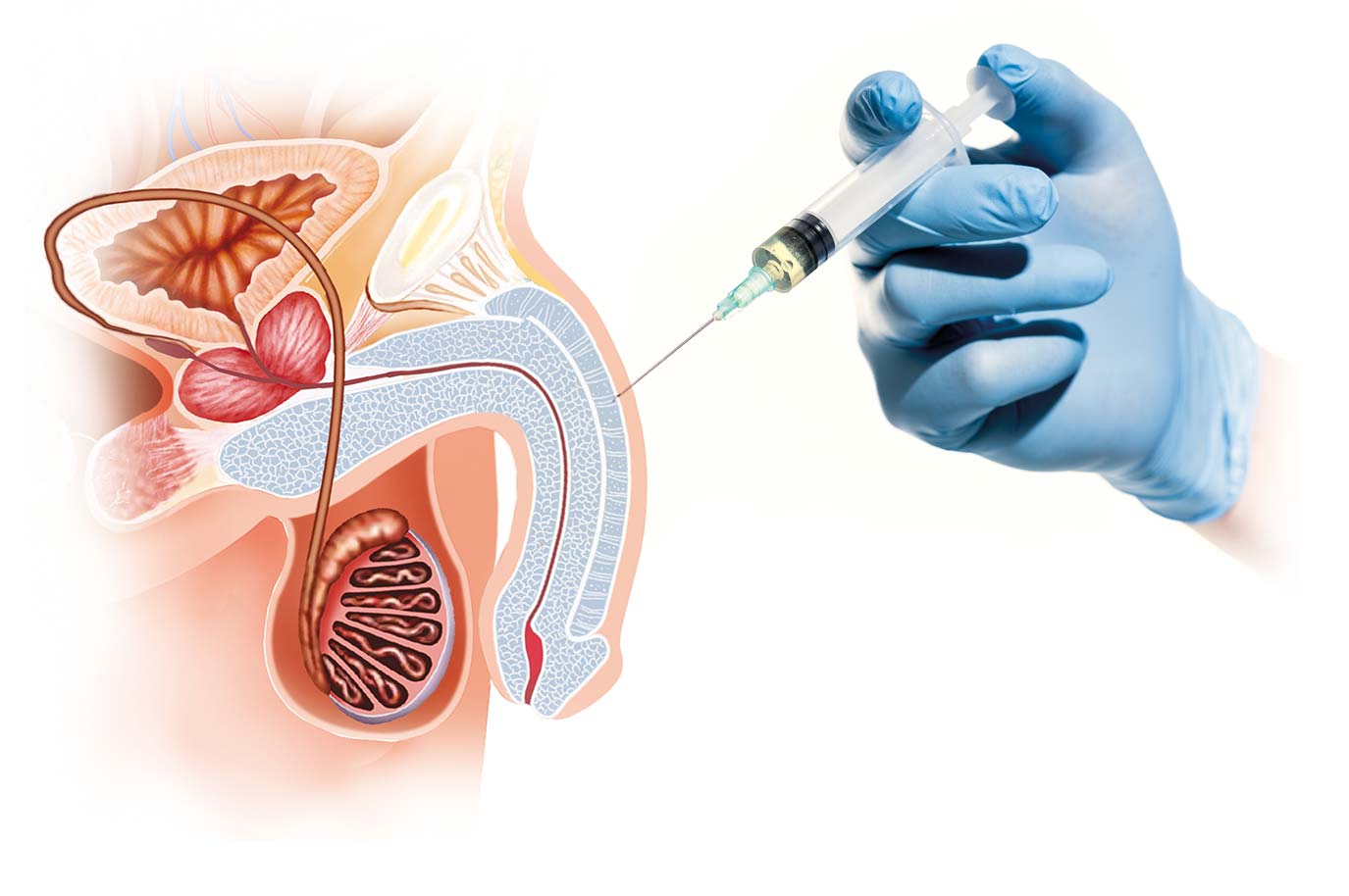 Thermoshock-Lipolysis-in-Warren-NJ-by-Firm-Lab-Warren-LLC P-Shot® for Men’s Sexual Wellness in Miami, FL