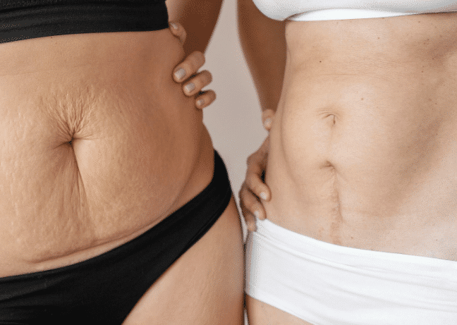 Stretch Mark Renewal Protocol in Miami, FL