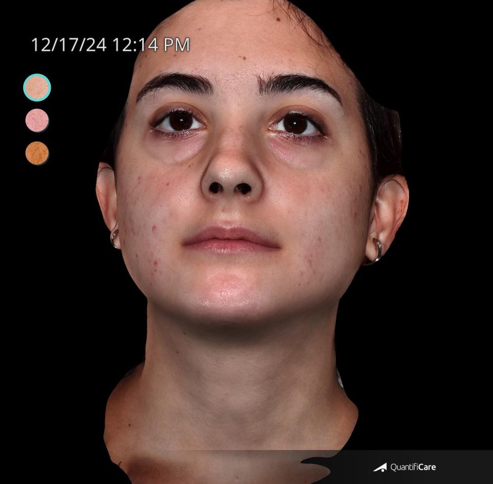 After Image: Acne Scar Resurfacing - front