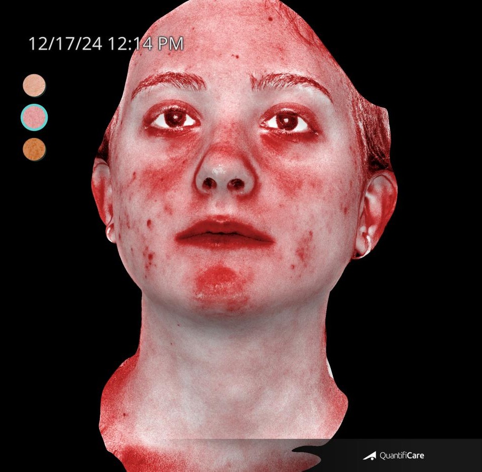 After Image: Acne Scar Resurfacing - front