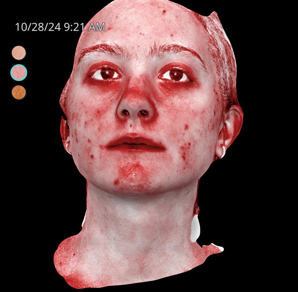 Before Image: Acne Scar Resurfacing - front