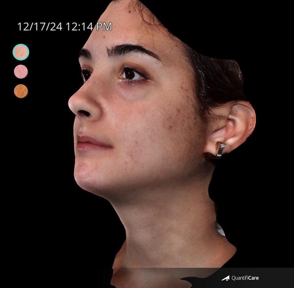 After Image: Acne Scar Resurfacing - left-front-oblique