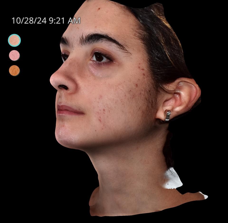 Before Image: Acne Scar Resurfacing - left-front-oblique