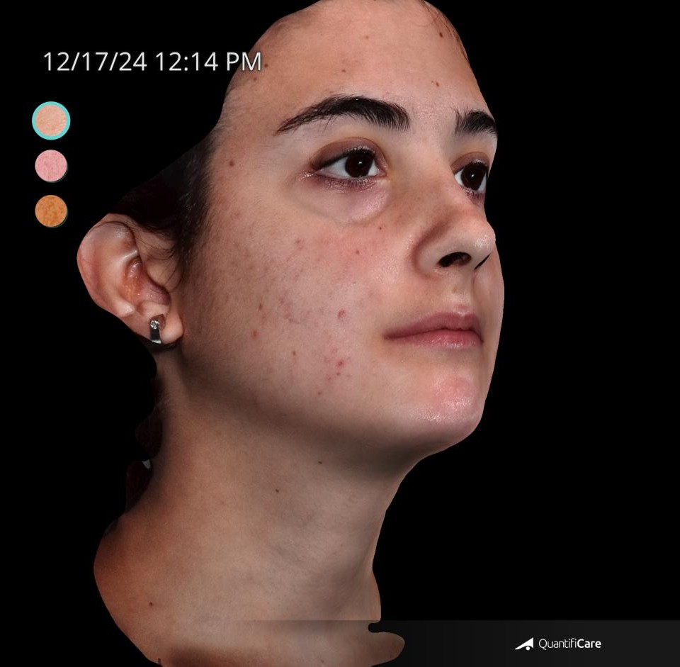 After Image: Acne Scar Resurfacing - right-front-oblique