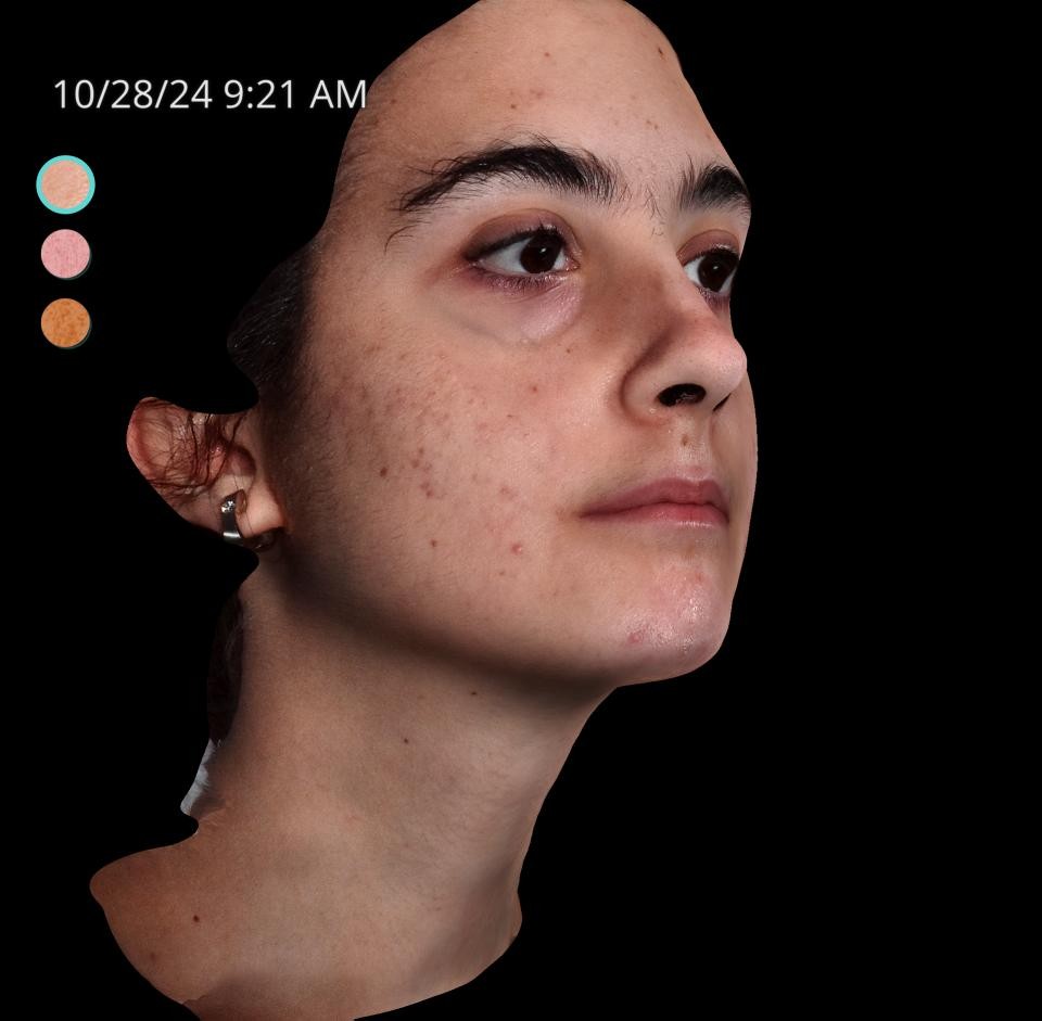 Before Image: Acne Scar Resurfacing - right-front-oblique