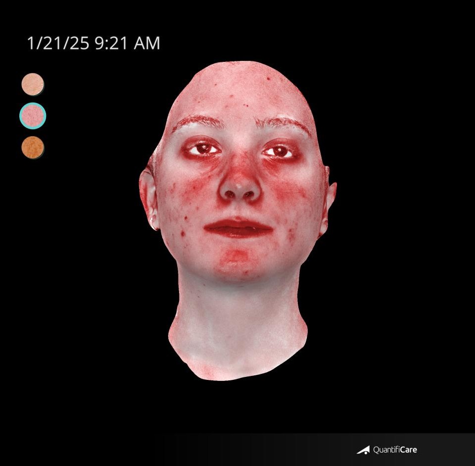 After Image: Acne Scar Resurfacing - front