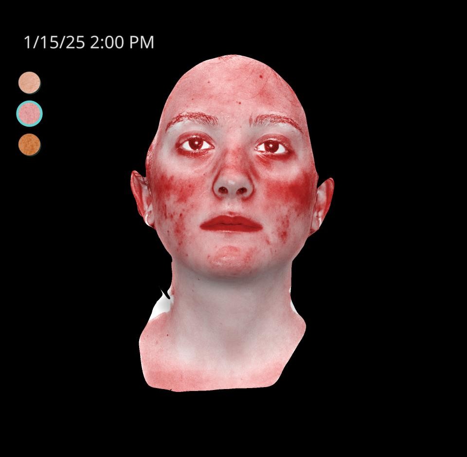 Before Image: Acne Scar Resurfacing - front