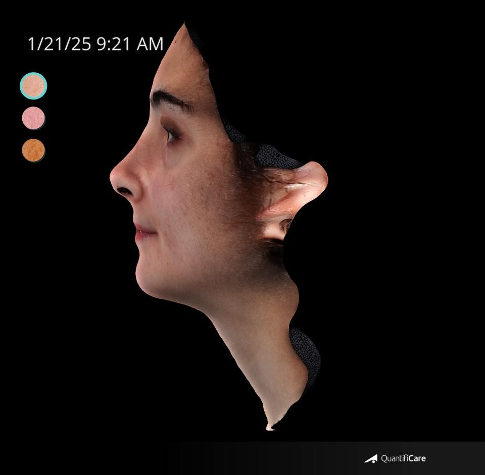 After Image: Acne Scar Resurfacing - left-side