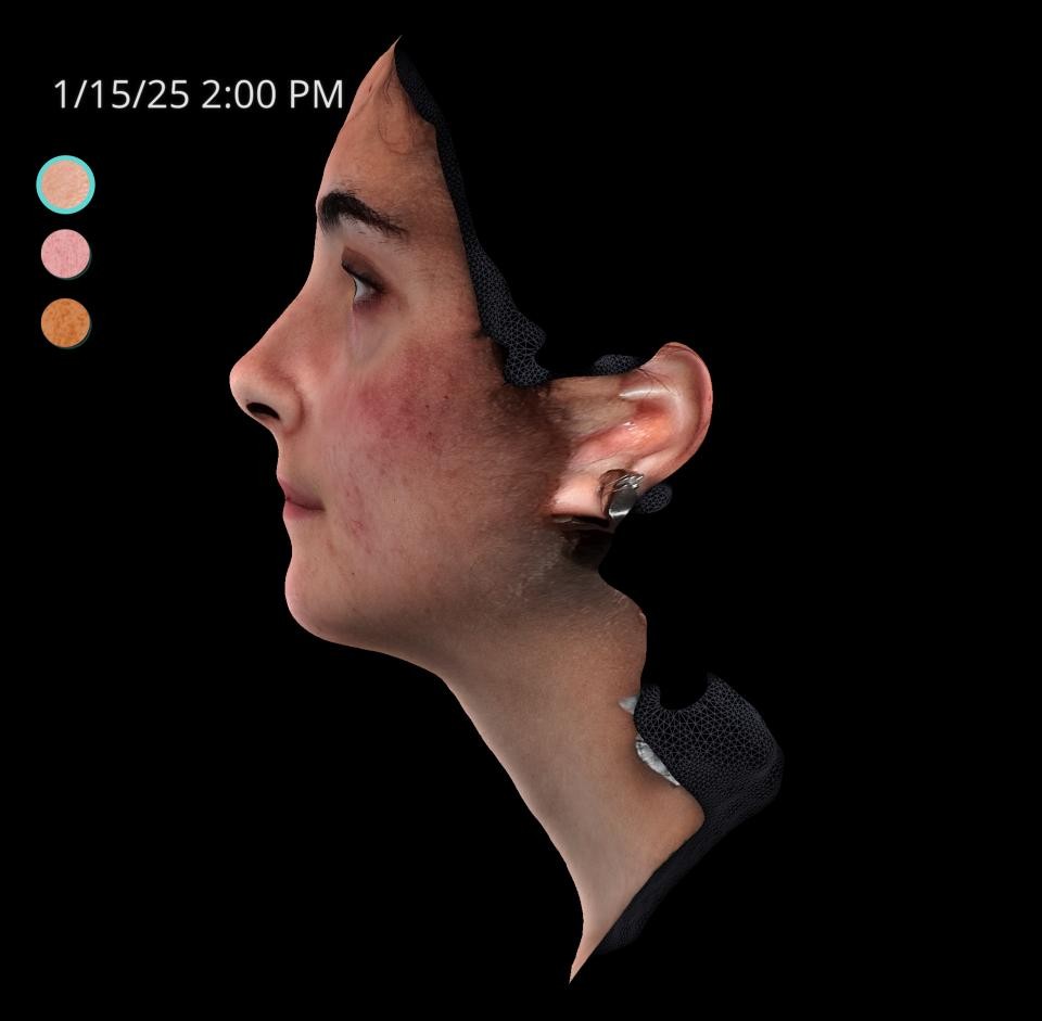 Before Image: Acne Scar Resurfacing - left-side