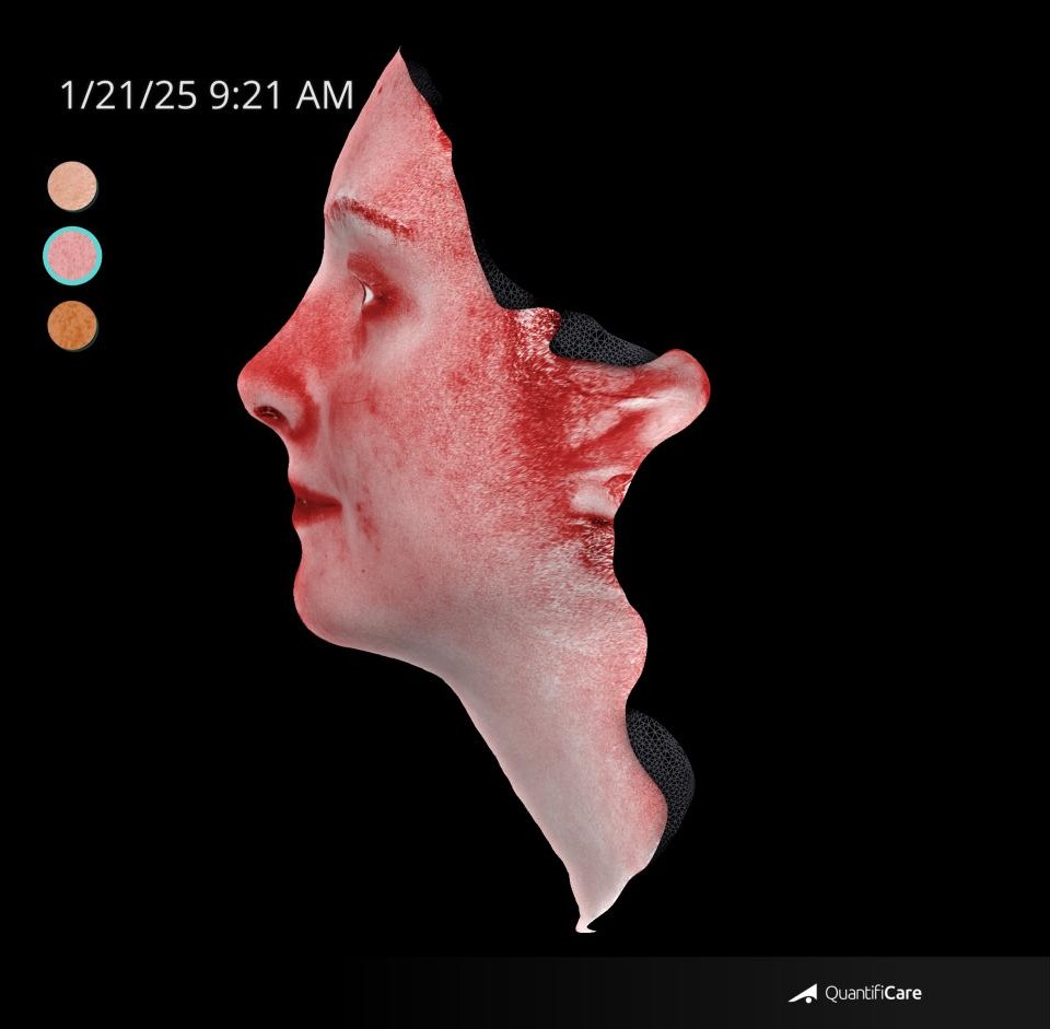 After Image: Acne Scar Resurfacing - left-side