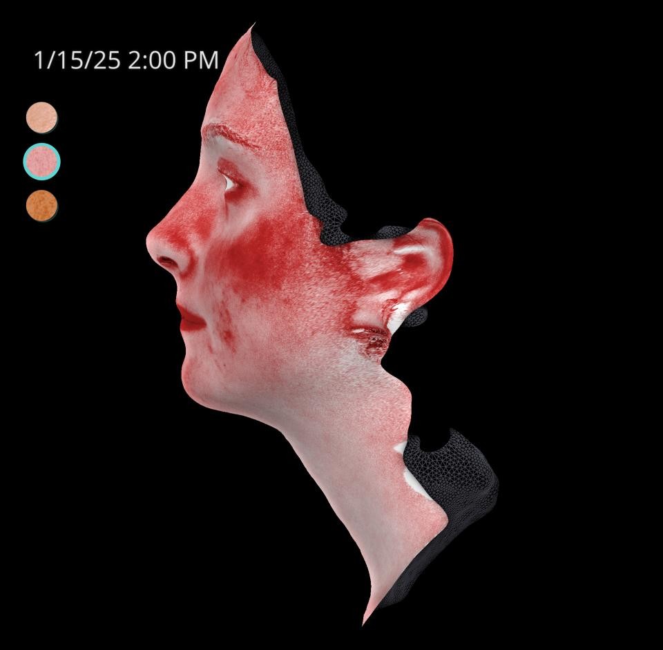 Before Image: Acne Scar Resurfacing - left-side