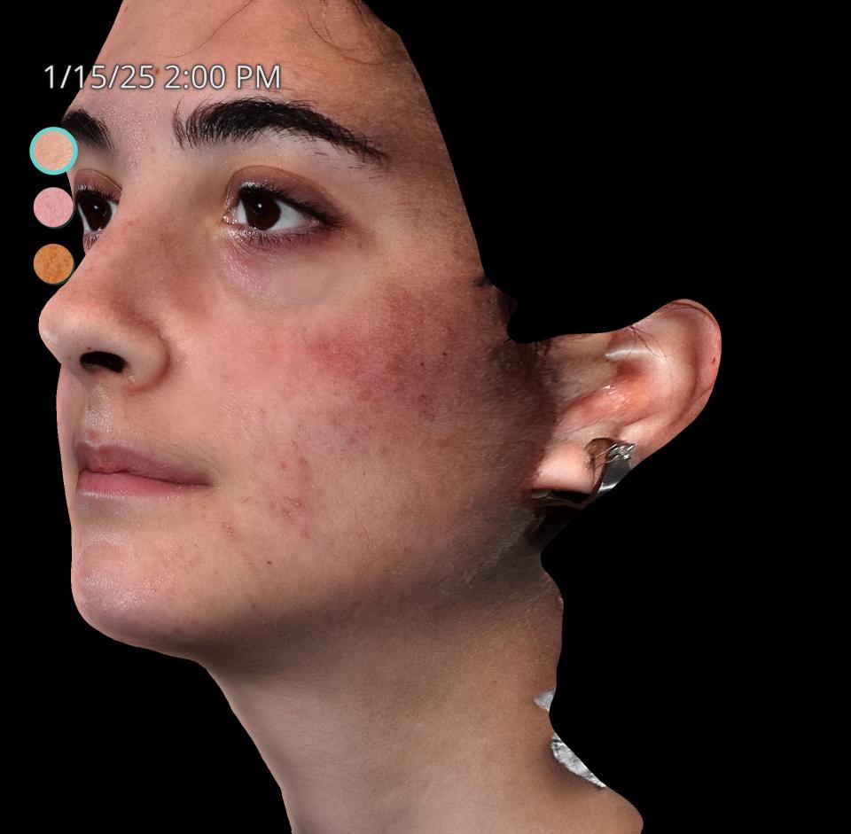 Before Image: Acne Scar Resurfacing - left-front-oblique