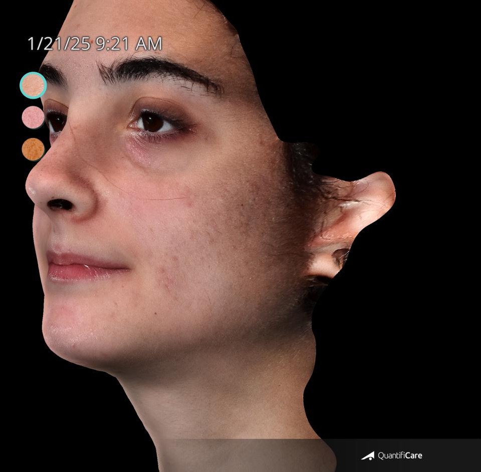 After Image: Acne Scar Resurfacing - left-front-oblique