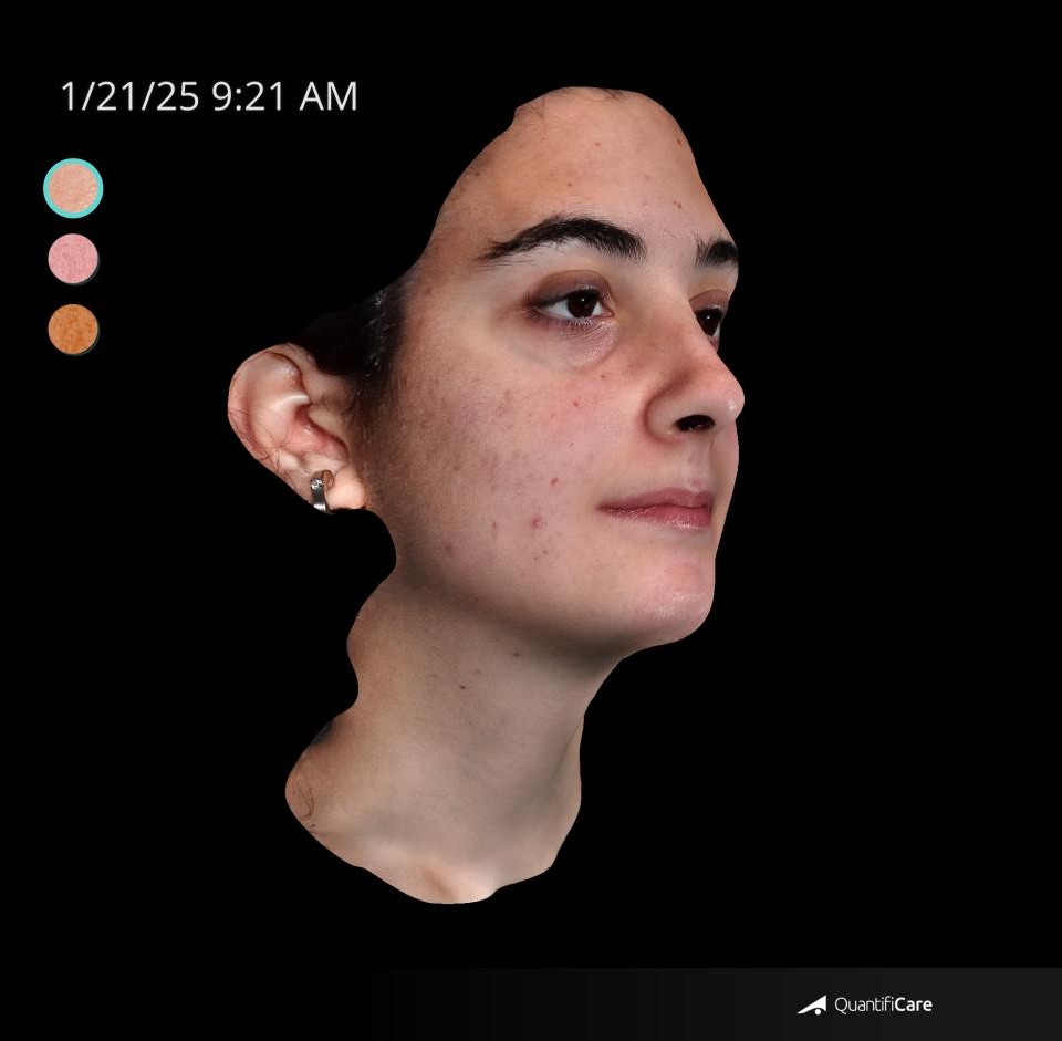 After Image: Acne Scar Resurfacing - right-front-oblique