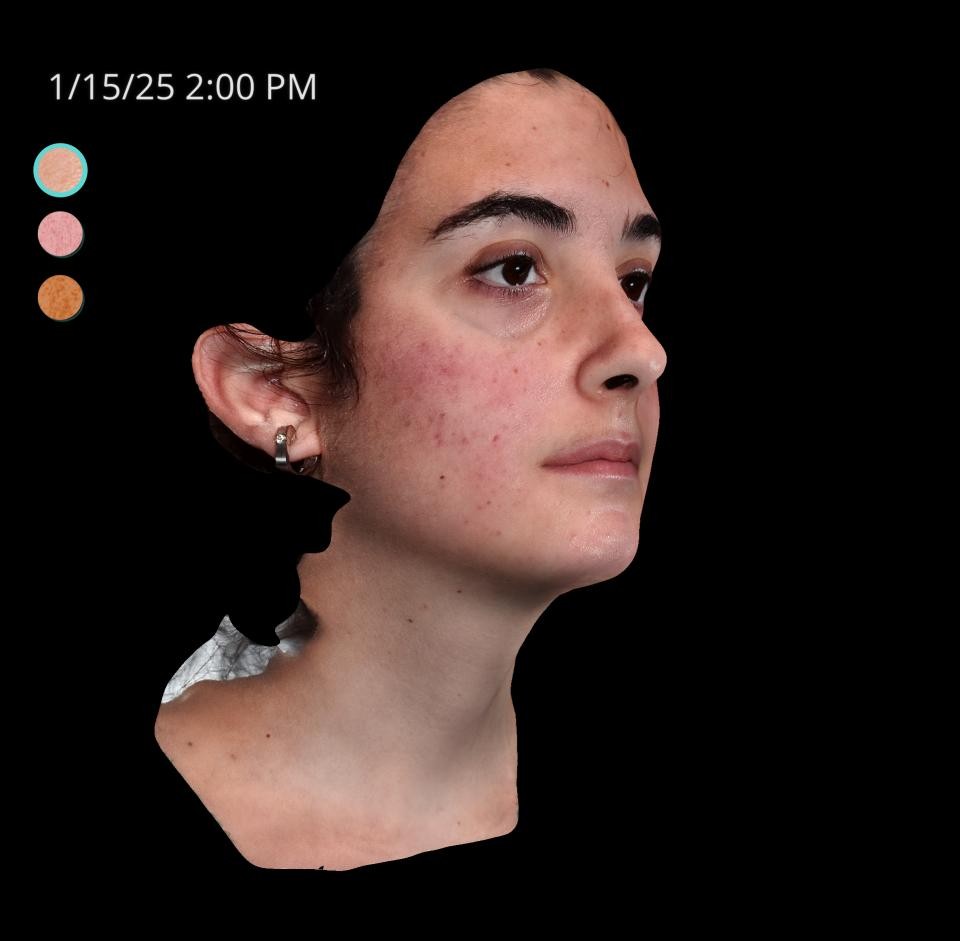 Before Image: Acne Scar Resurfacing - right-front-oblique