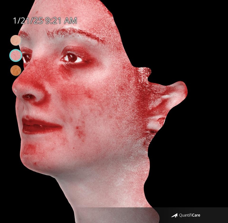 After Image: Acne Scar Resurfacing - left-front-oblique