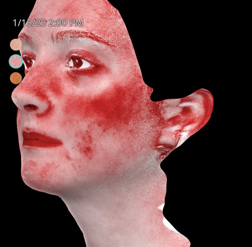 Before Image: Acne Scar Resurfacing - left-front-oblique