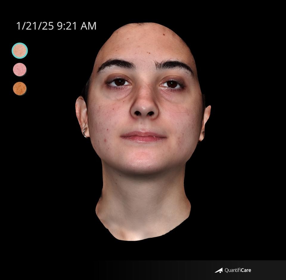 After Image: Acne Scar Resurfacing - front