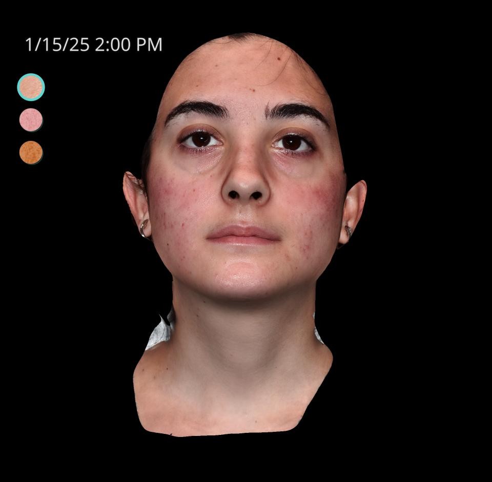 Before Image: Acne Scar Resurfacing - front