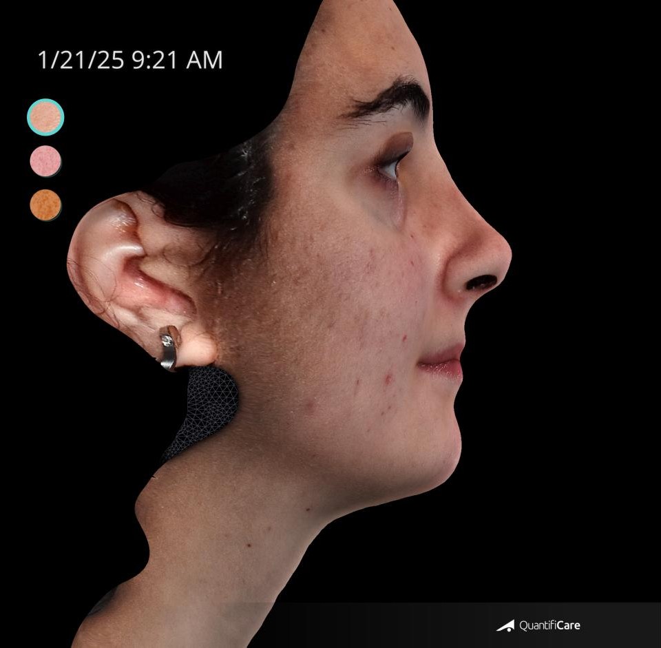 After Image: Acne Scar Resurfacing - right-side