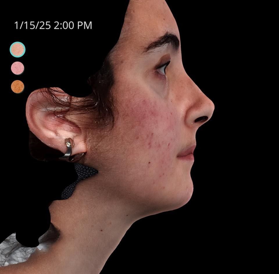 Before Image: Acne Scar Resurfacing - right-side