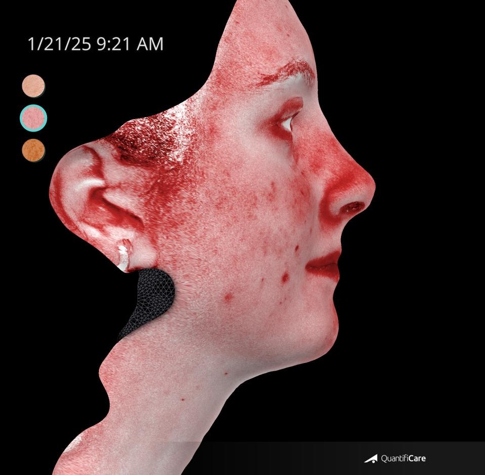 After Image: Acne Scar Resurfacing - right-side