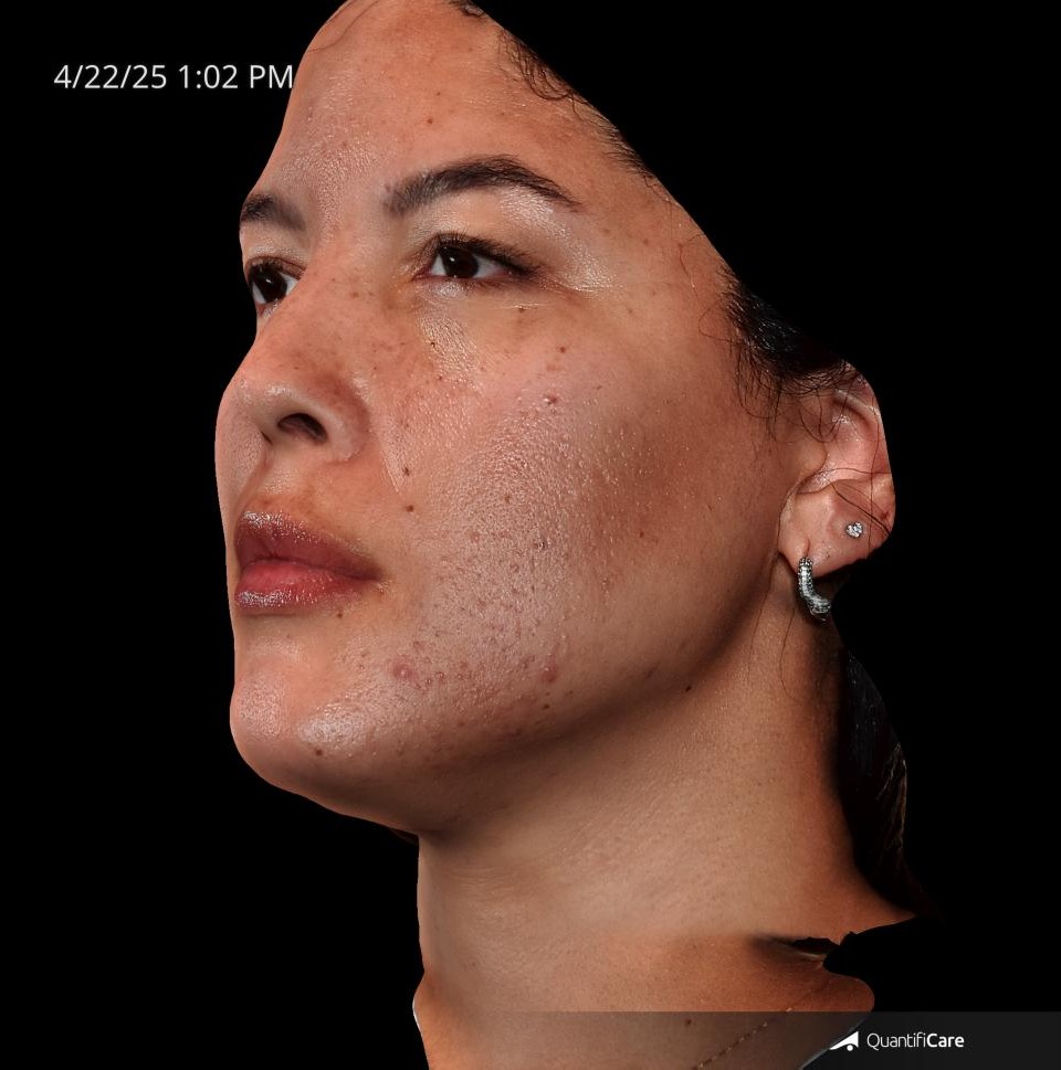 After Image: Acne Scar Resurfacing - left-front-oblique