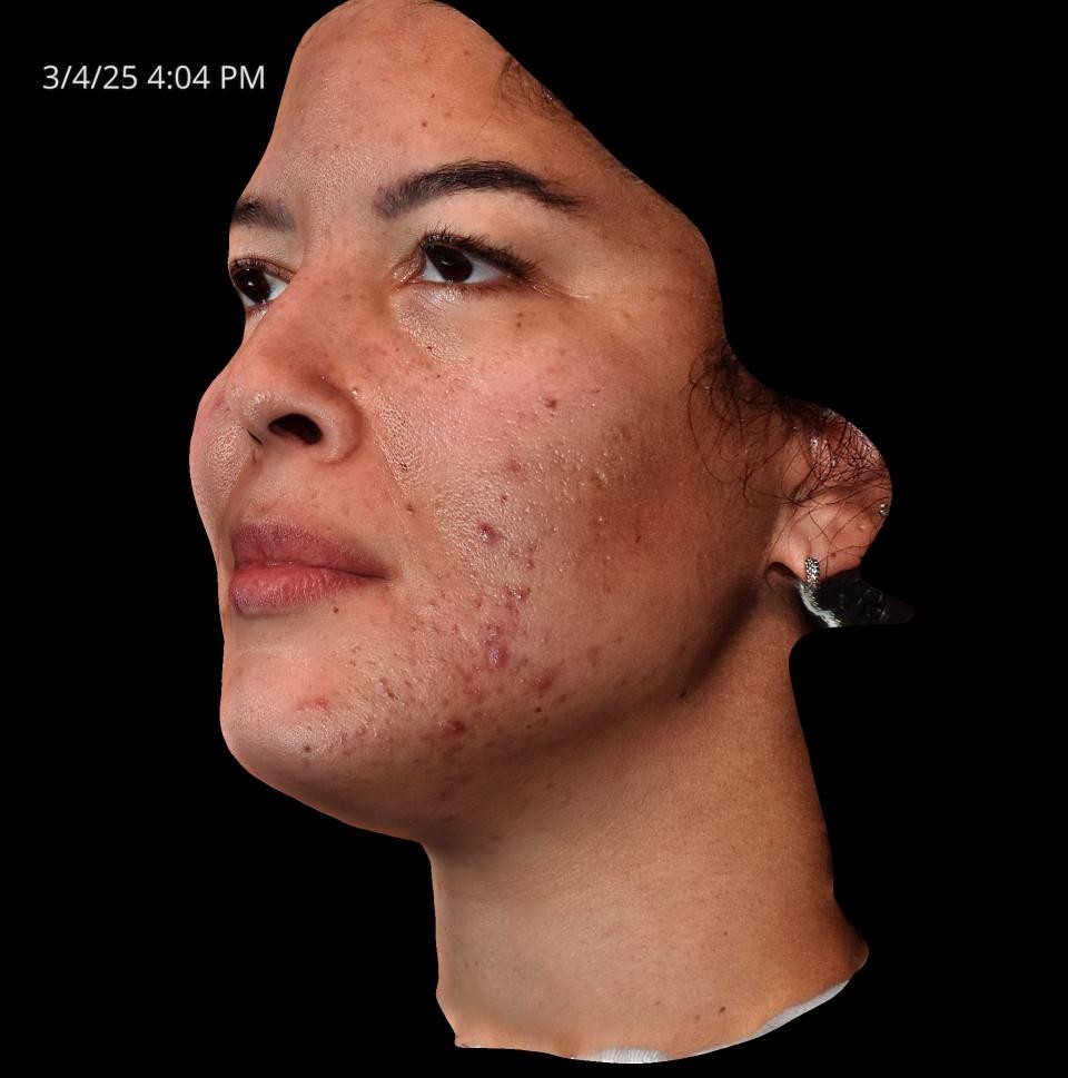 Before Image: Acne Scar Resurfacing - left-front-oblique