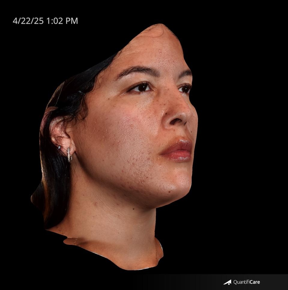 After Image: Acne Scar Resurfacing - right-front-oblique