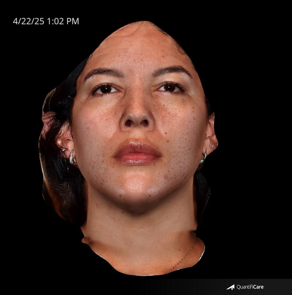 After Image: Acne Scar Resurfacing - front