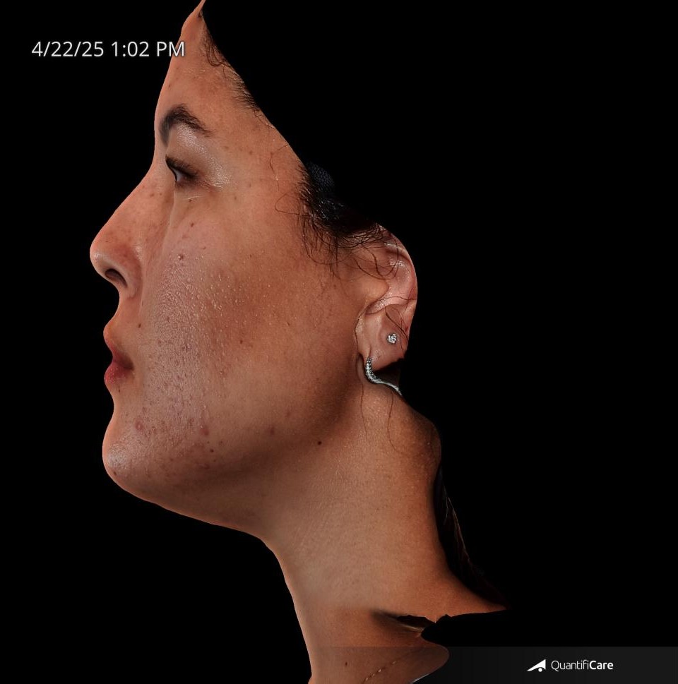 After Image: Acne Scar Resurfacing - left-side