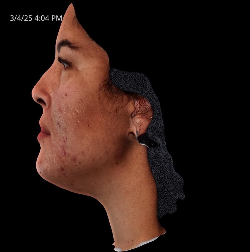 Before Image: Acne Scar Resurfacing - left-side