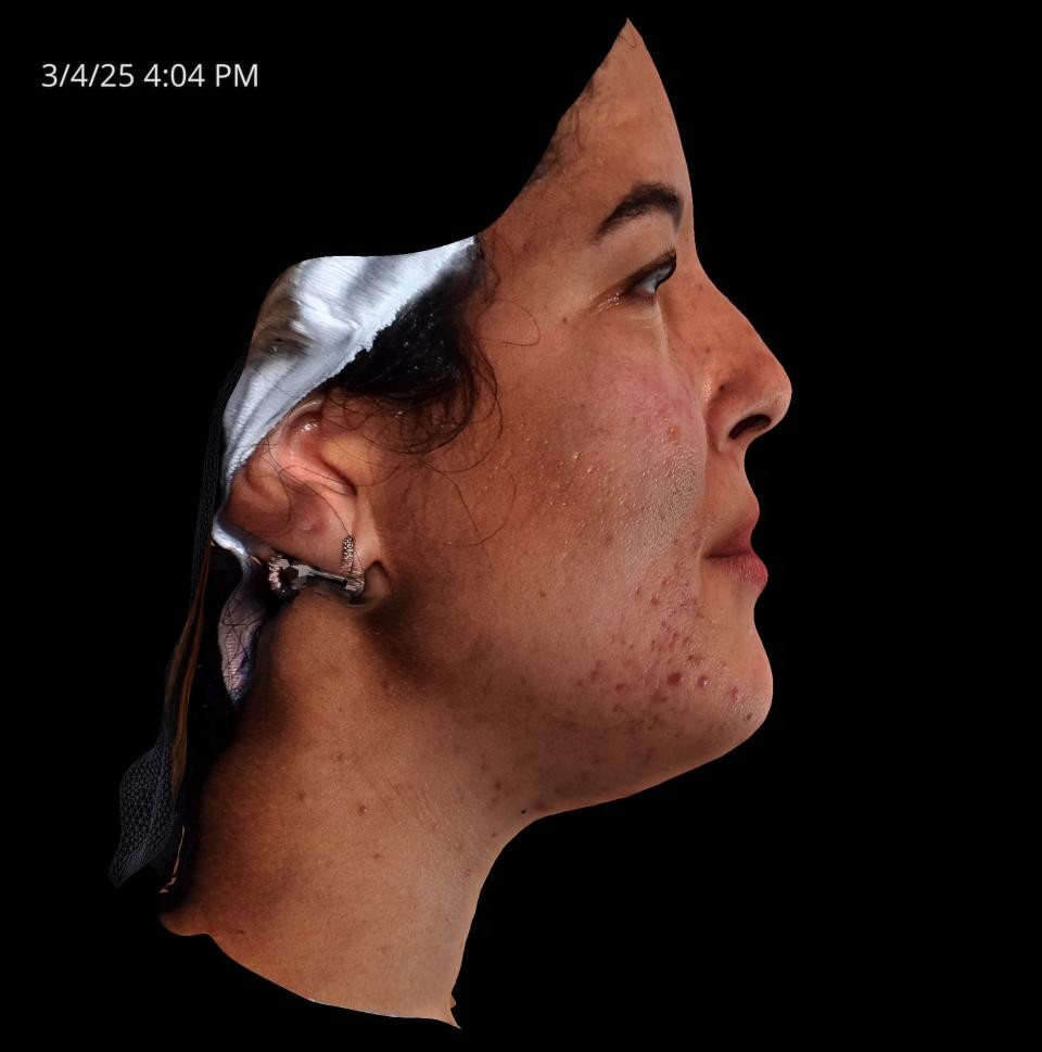 Before Image: Acne Scar Resurfacing - right-side