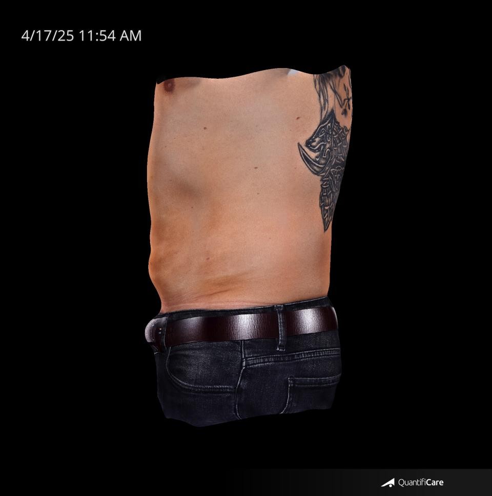 After Image: Endo-One - left-side