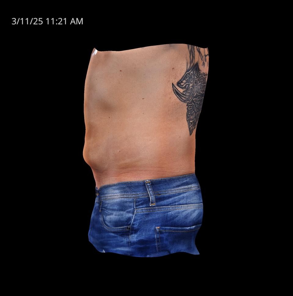 Before Image: Endo-One - left-side