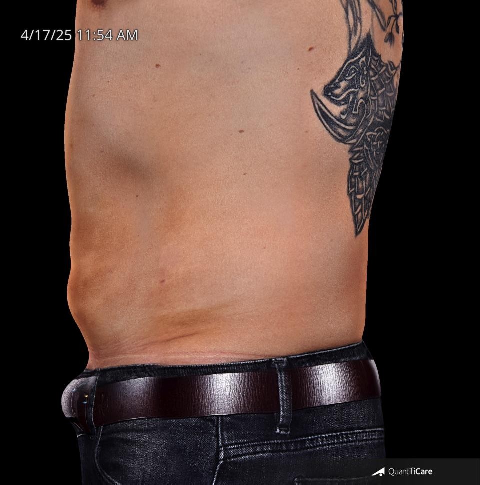 After Image: Endo-One - left-side