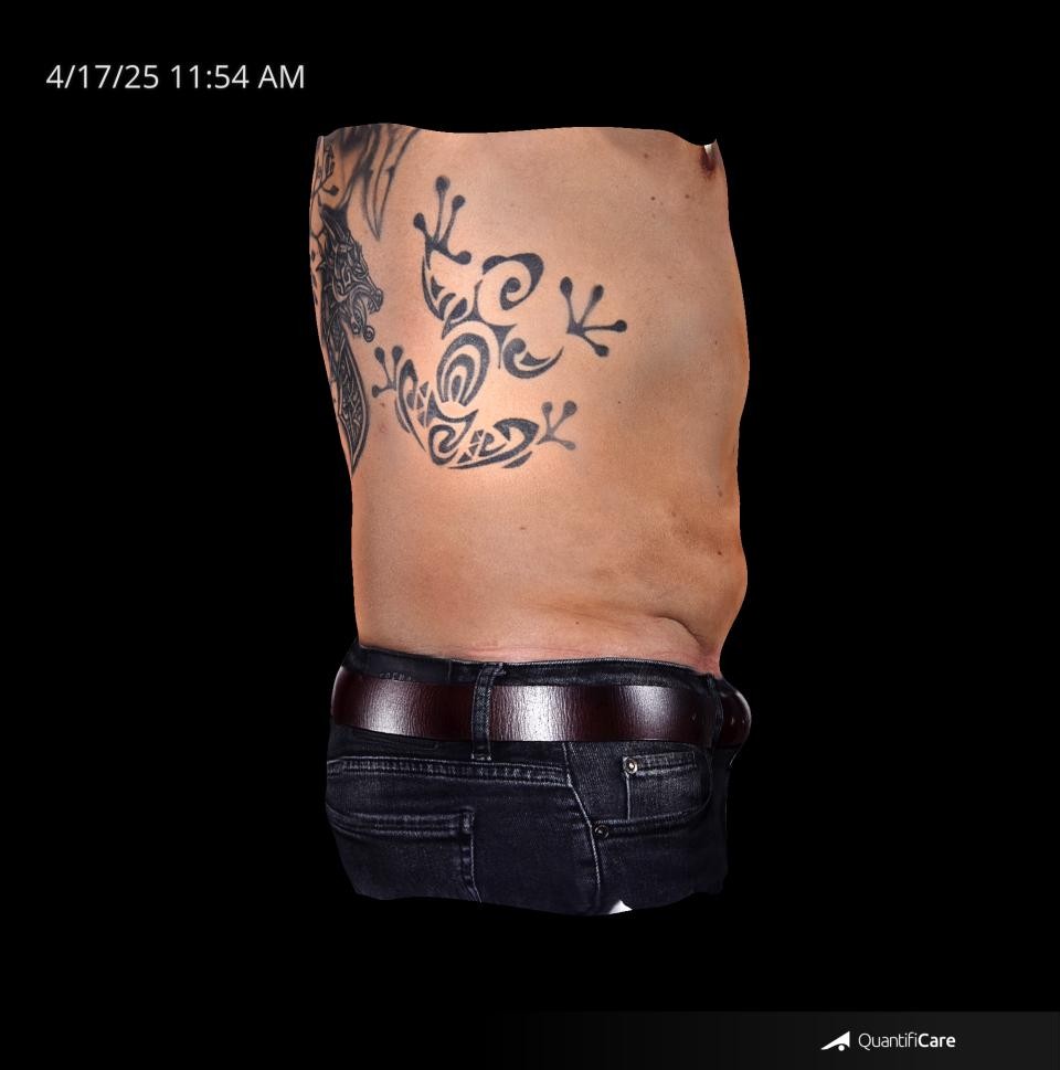 After Image: Endo-One - right-side