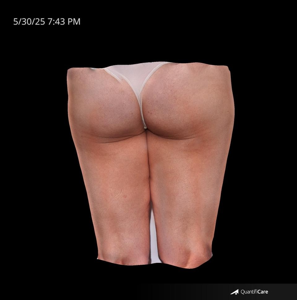 After Image: Cellulite - back