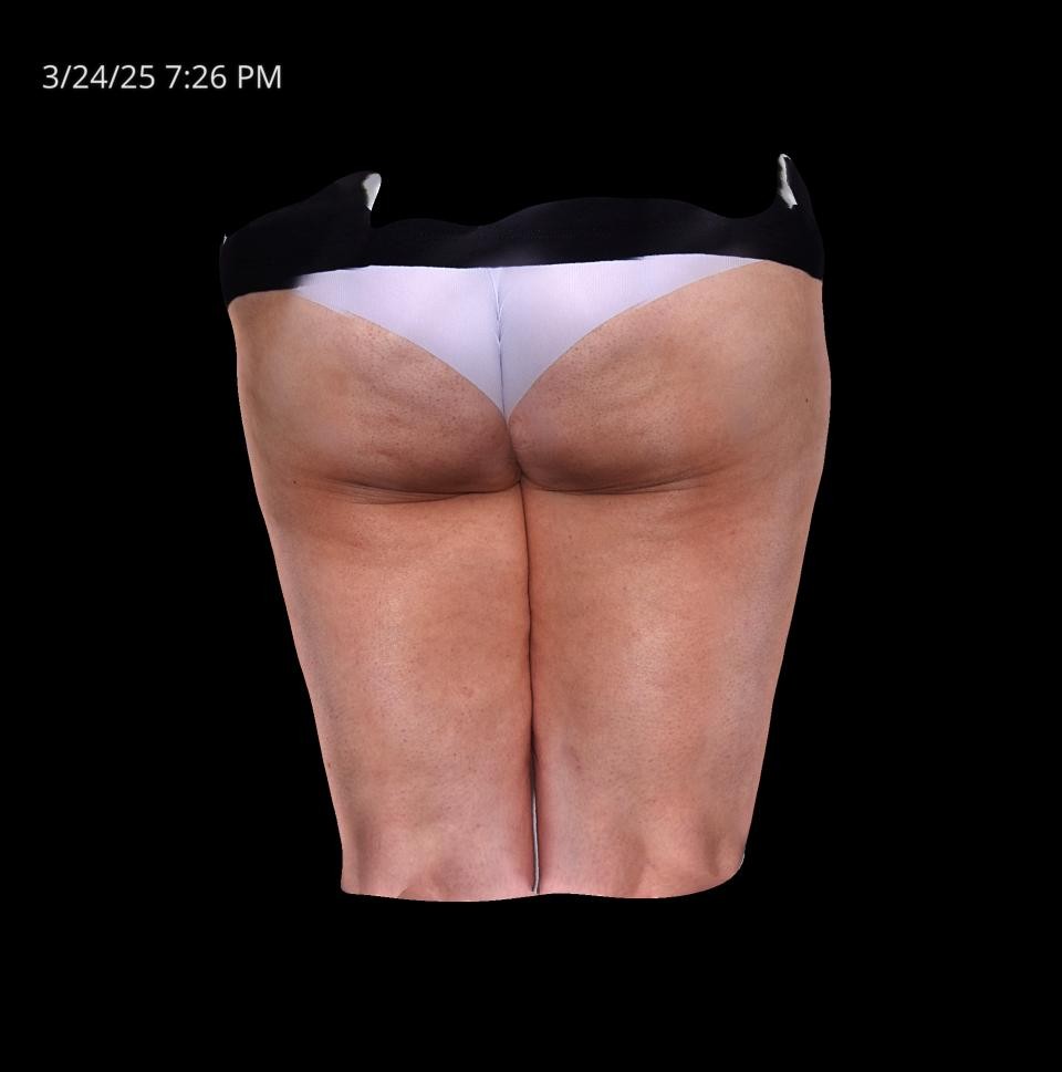 Before Image: Cellulite - back