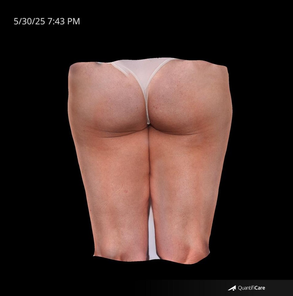 After Image: Cellulite - back