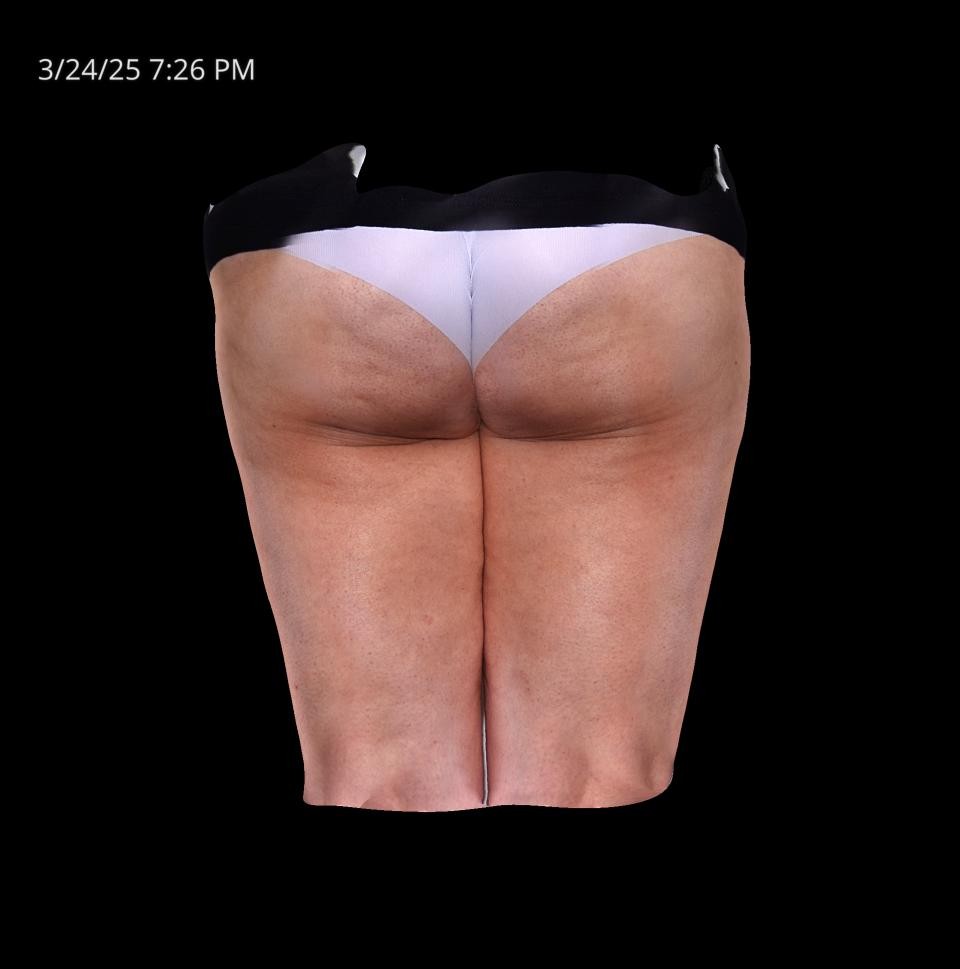 Before Image: Cellulite - back