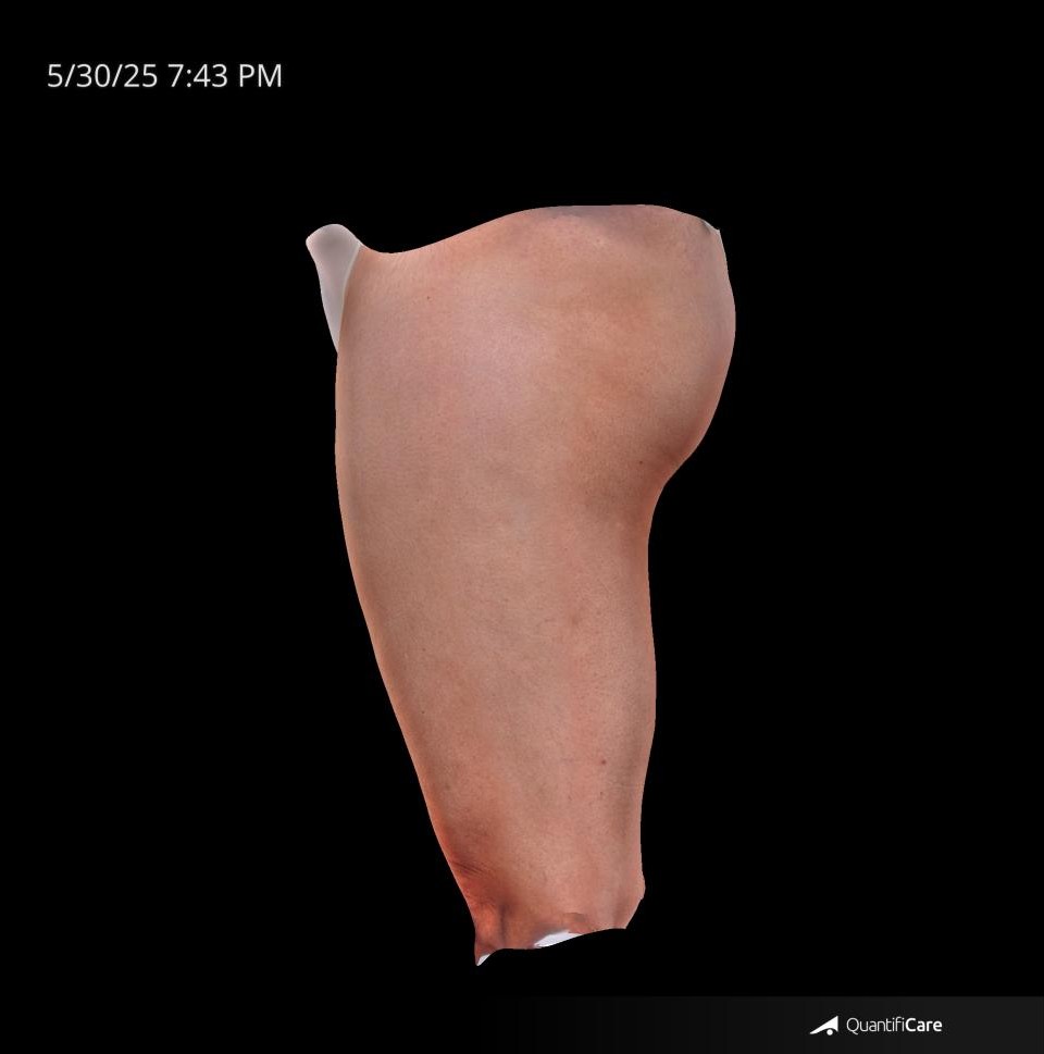 After Image: Cellulite - left-side