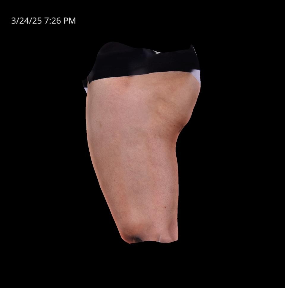 Before Image: Cellulite - left-side