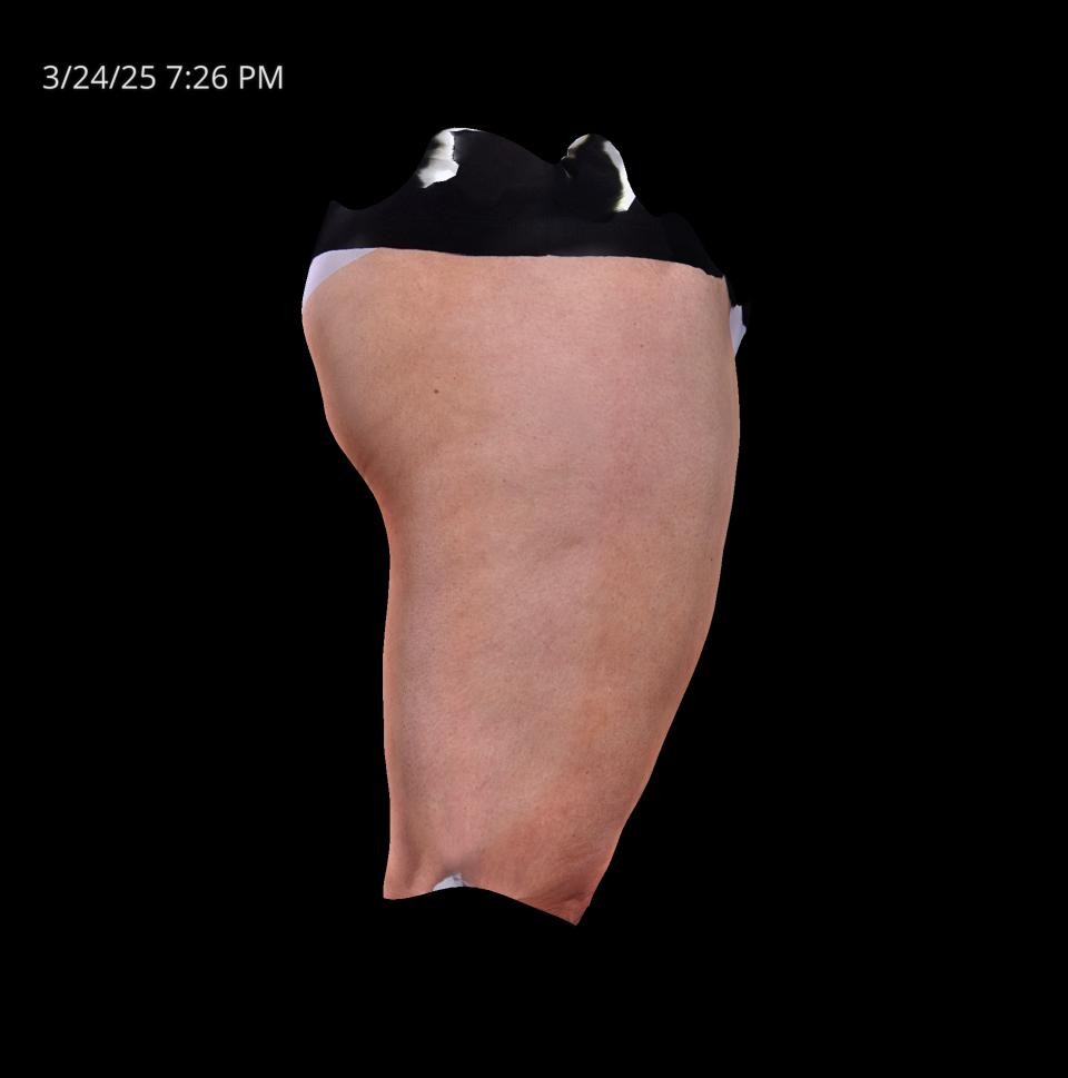 Before Image: Cellulite - right-side