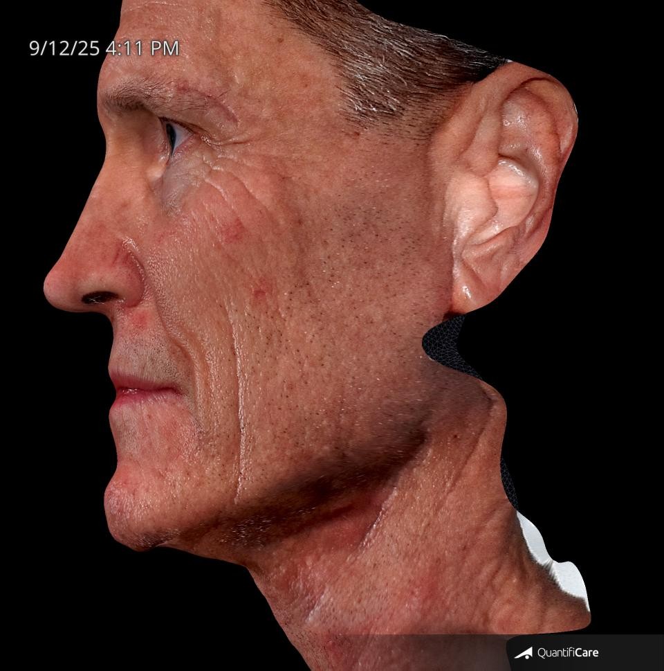 After Image: Endo-One - left-side