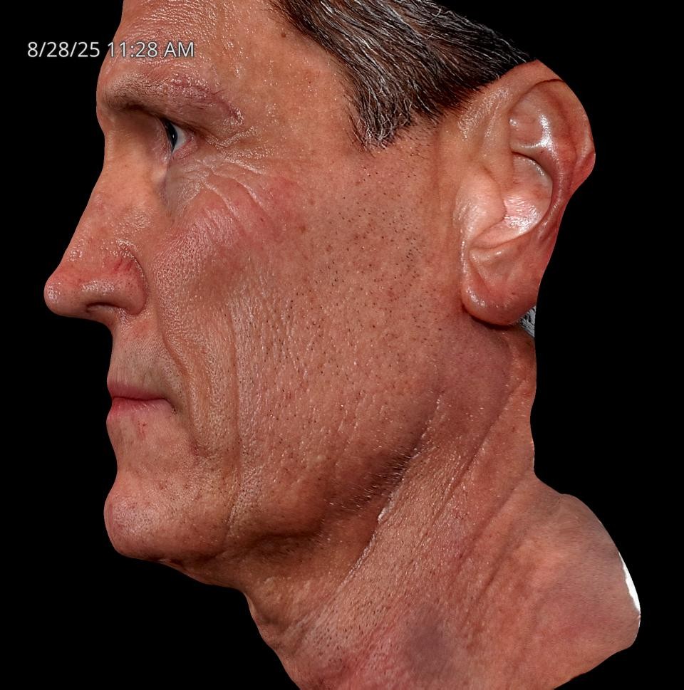 Before Image: Endo-One - left-side