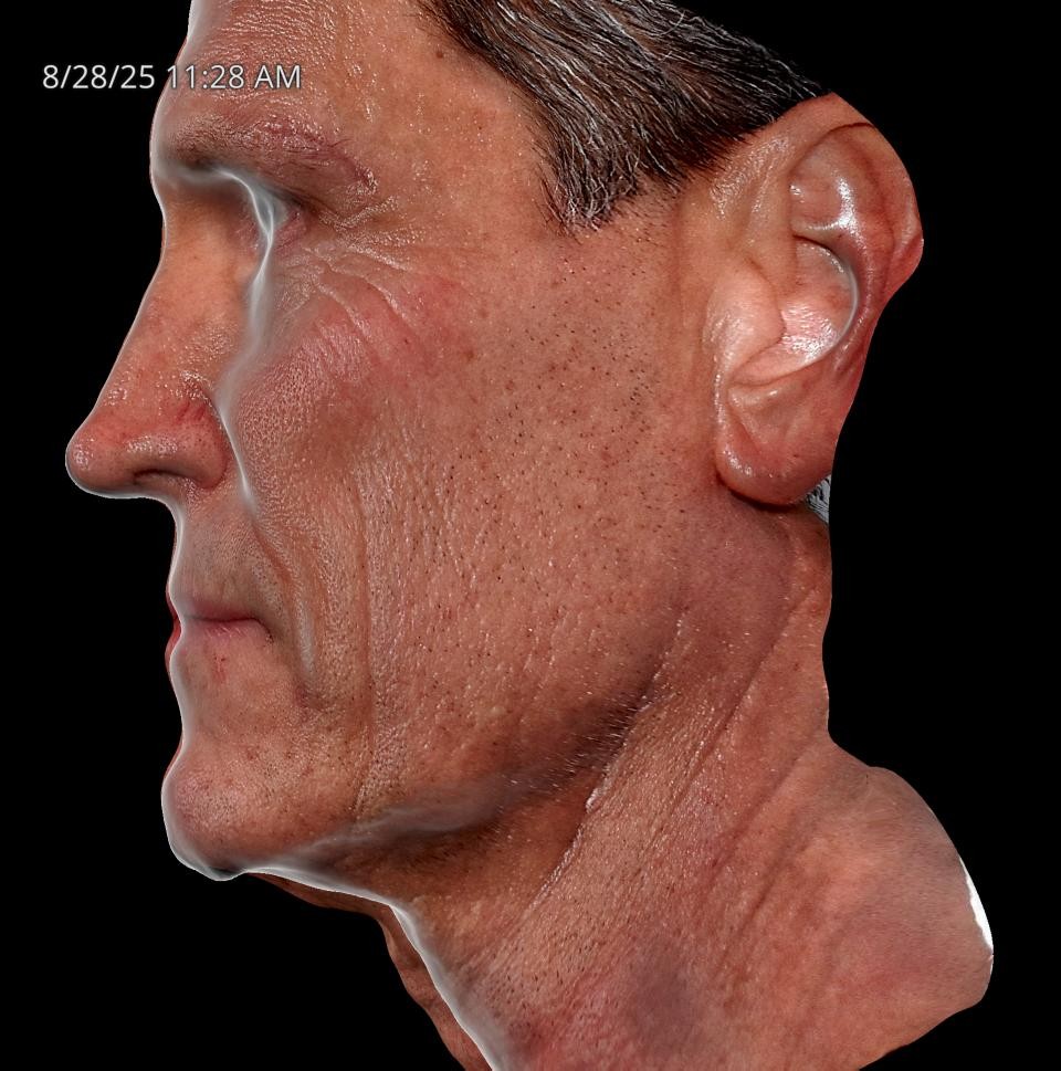 Before Image: Endo-One - left-side