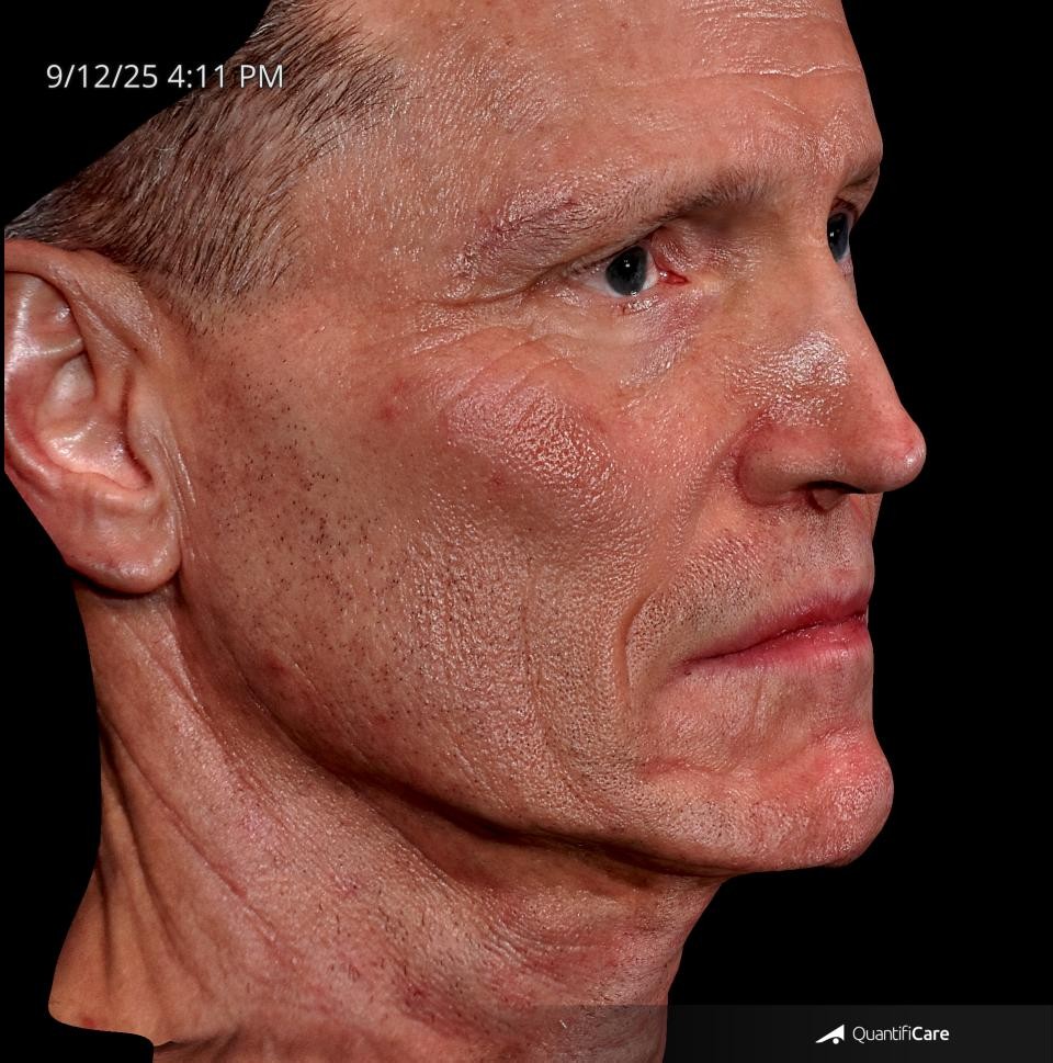 After Image: Endo-One - right-front-oblique